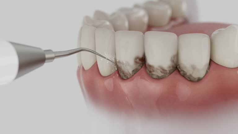 Reliable Dental Implants contractor in Tucker, GA by Smile Center Dentistry